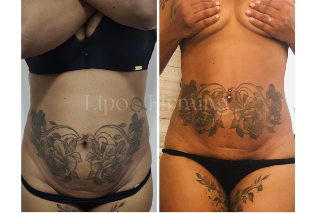 antes e depois Lipo e firming (16)