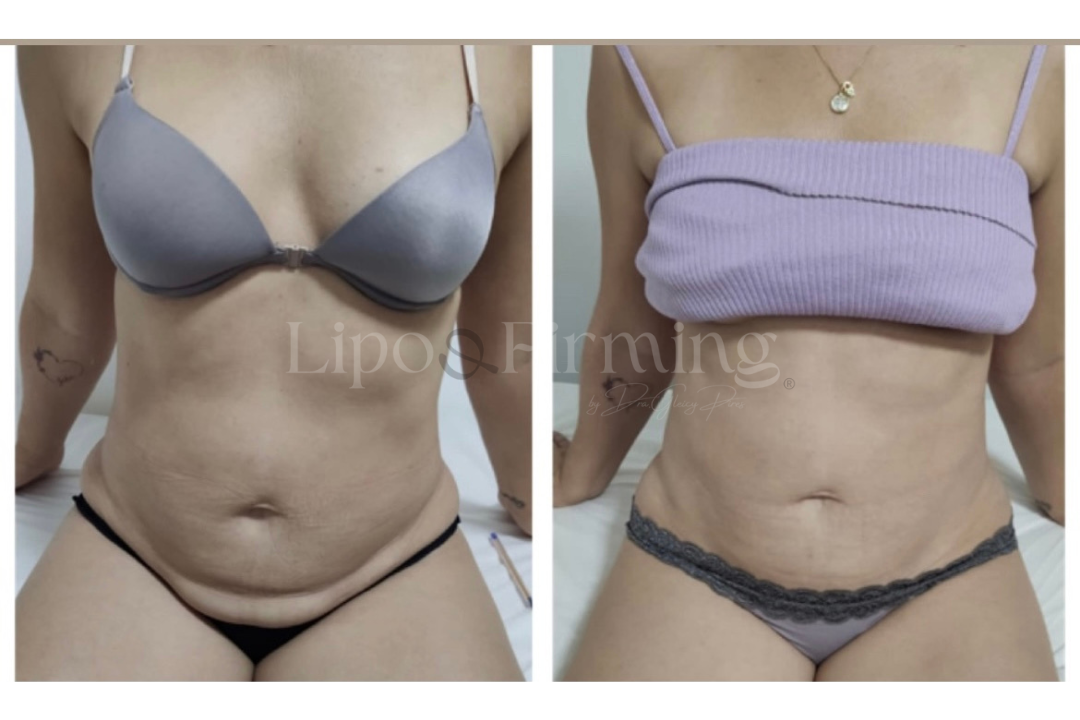 antes e depois Lipo e firming (17)