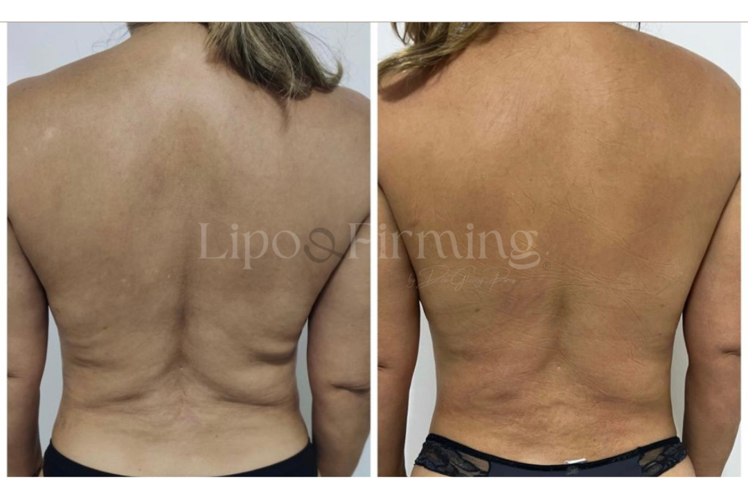 antes e depois Lipo e firming (18)