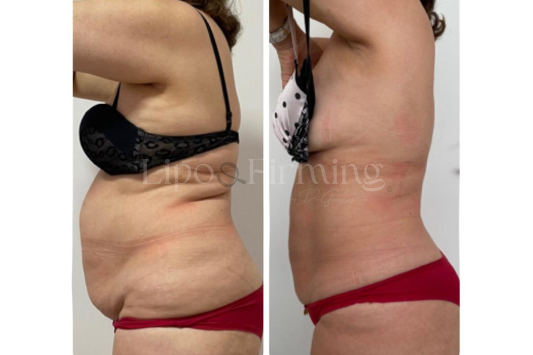 antes e depois Lipo e firming (20)