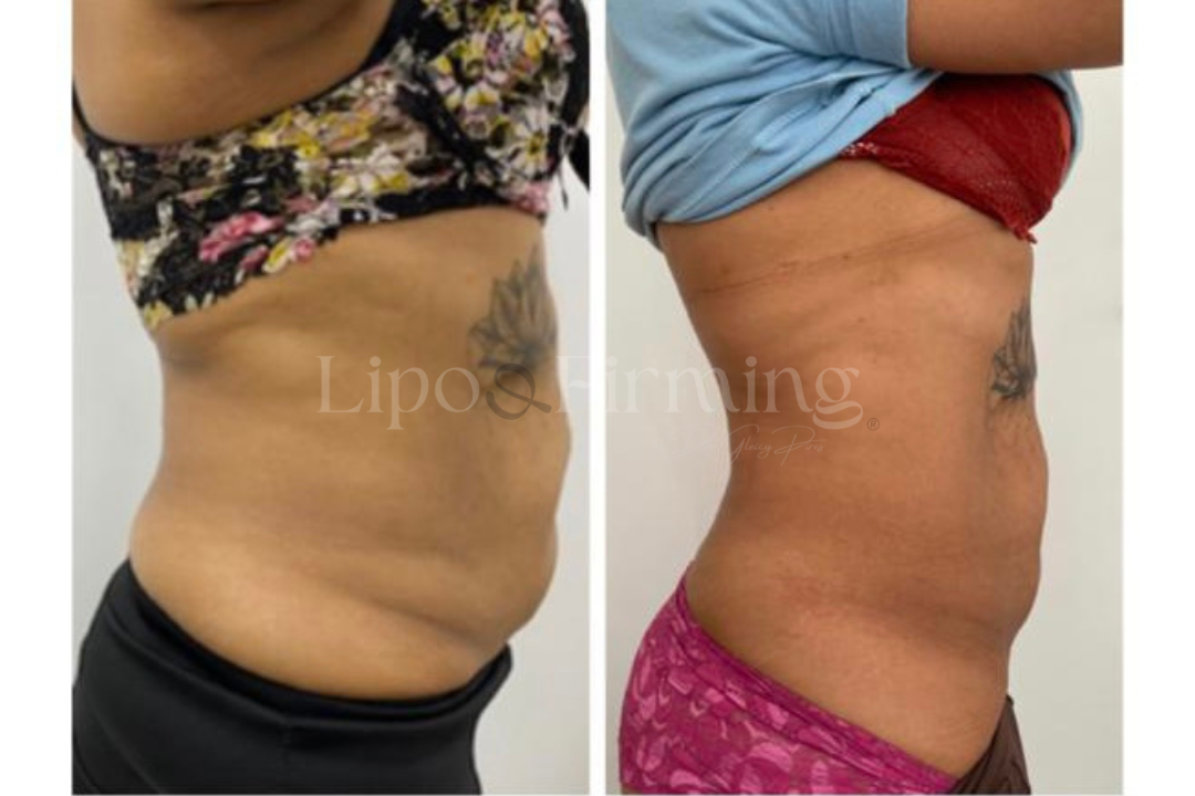 antes e depois Lipo e firming (21)