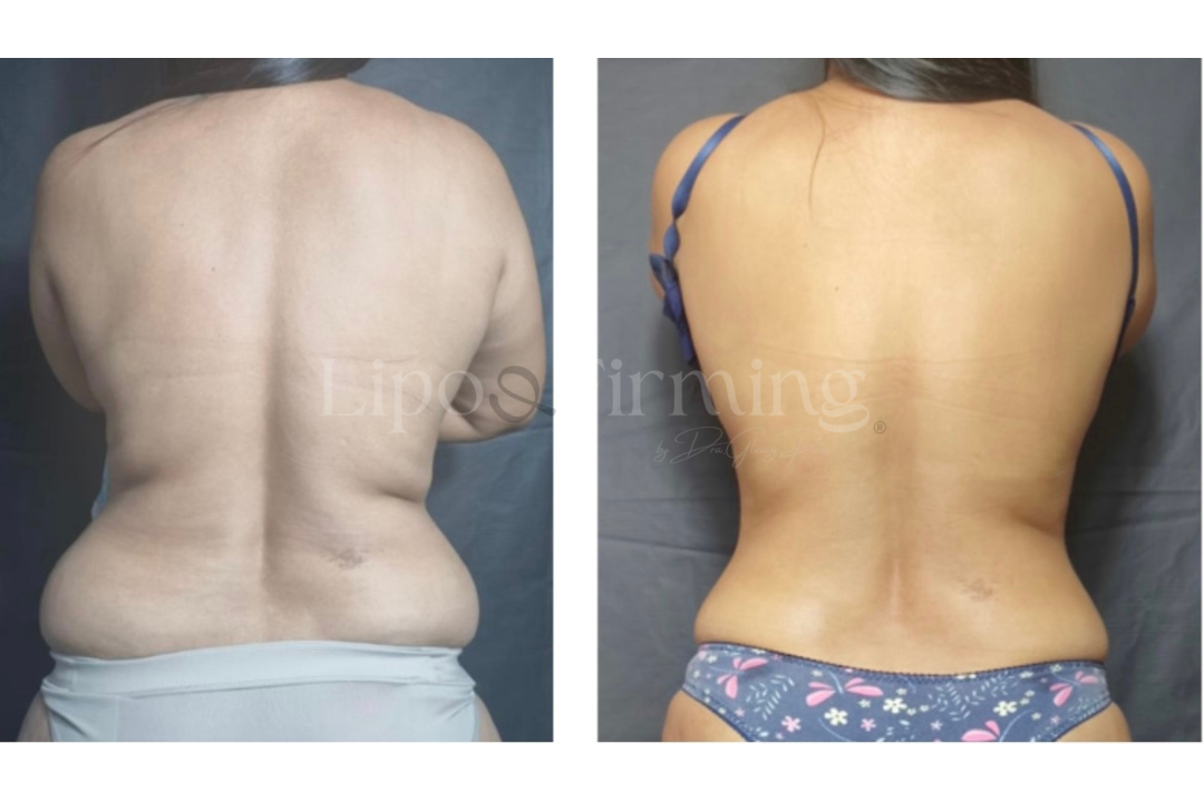 antes e depois Lipo e firming (23)