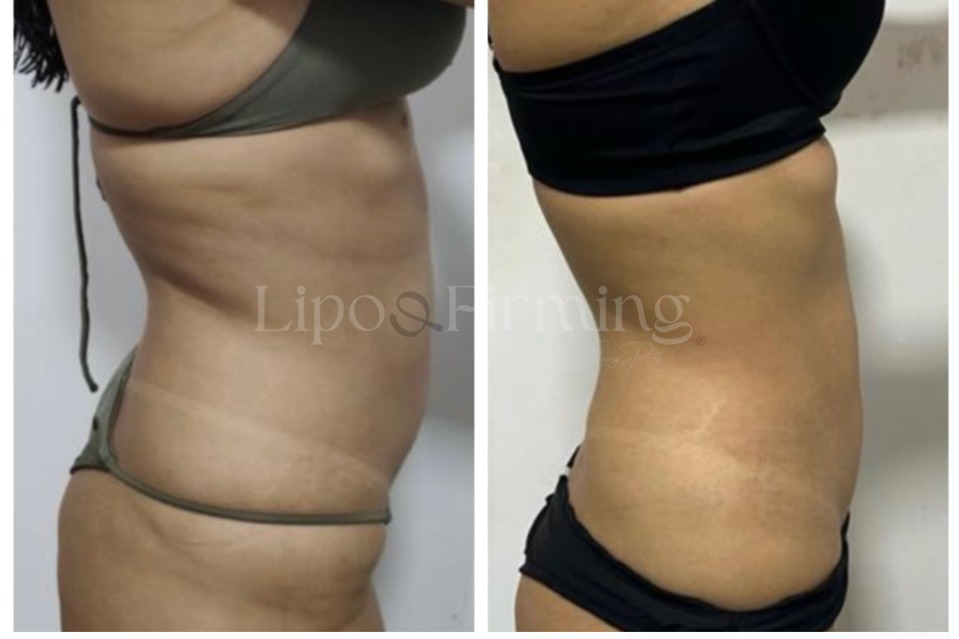 antes e depois Lipo e firming (24)