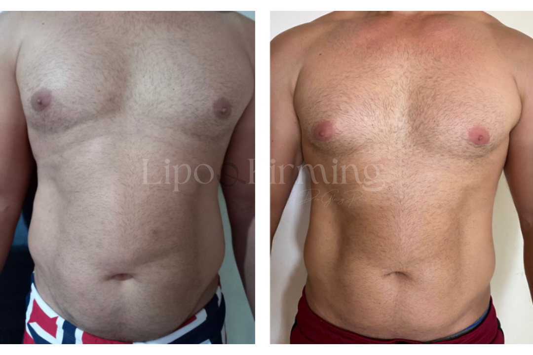 antes e depois Lipo e firming (25)
