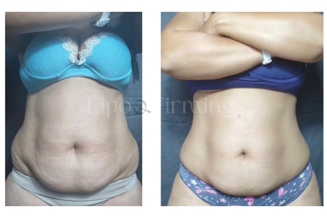 antes e depois Lipo e firming (26)