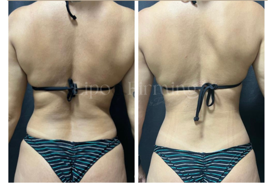 antes e depois Lipo e firming (27)