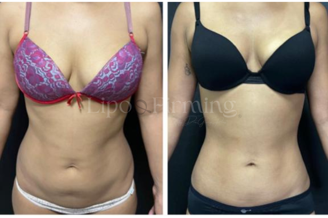 antes e depois Lipo e firming (28)