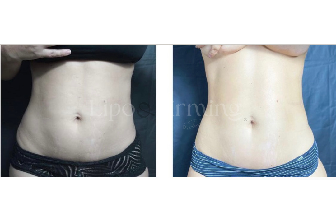 antes e depois Lipo e firming (29)