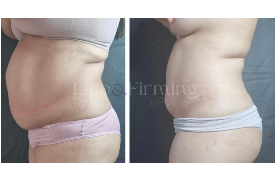antes e depois Lipo e firming (30)