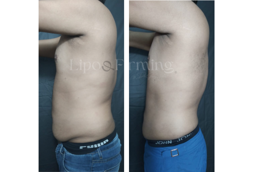 antes e depois Lipo e firming (16)